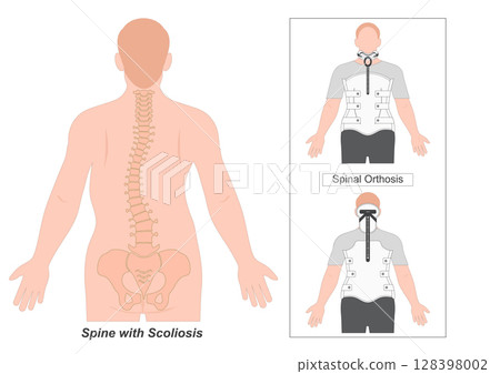 Spinal Orthosis that spans the thoracic. 128398002