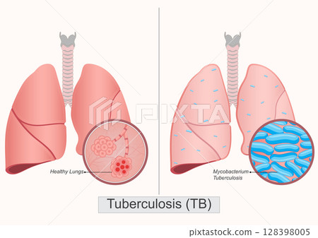 Tuberculosis (TB) is a potentially serious infectious disease. 128398005