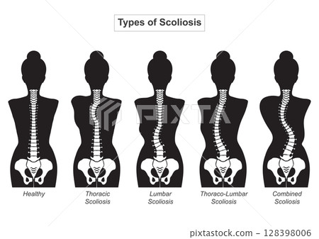 White spine on a black body. Scoliosis is a side to side curve. White spine on a black body. Scoliosis is a side to side curve. 128398006