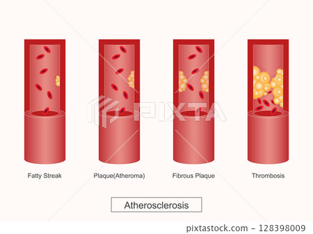 Atherosclerosis is a disease where plaque builds up inside arteries. Atherosclerosis is a disease where plaque builds up inside arteries. 128398009