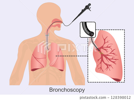 Bronchoscopy is a procedure that lets doctors look at lungs and air passages. 128398012