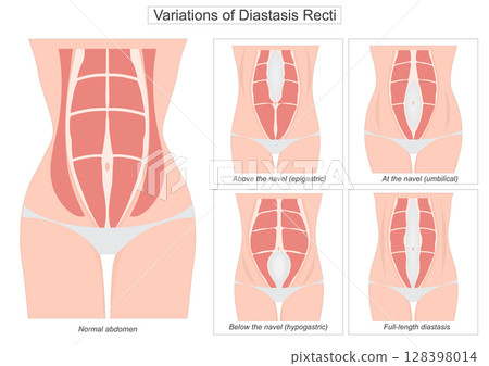 Diastasis recti is a condition where the rectus abdominis the six-pack muscles separate along. Diastasis recti is a condition where the rectus abdominis the six-pack muscles separate along. 128398014