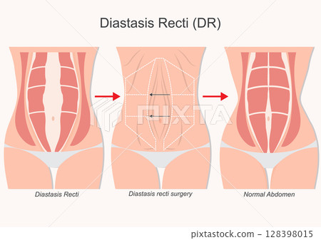 Diastasis recti surgery often part of a tummy tuck. 128398015