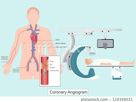 A coronary angiogram CAG is a test that uses X rays to look at the heart A coronary angiogram CAG is a test that uses X rays to look at the heart 128398031
