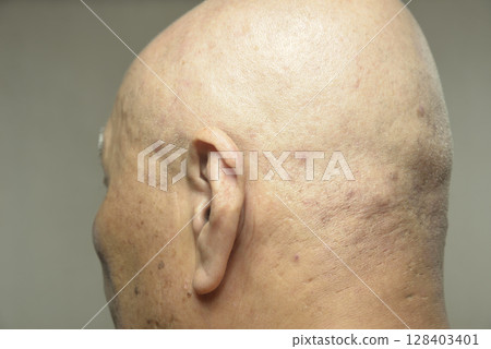 老人後腦勺皮膚病 128403401