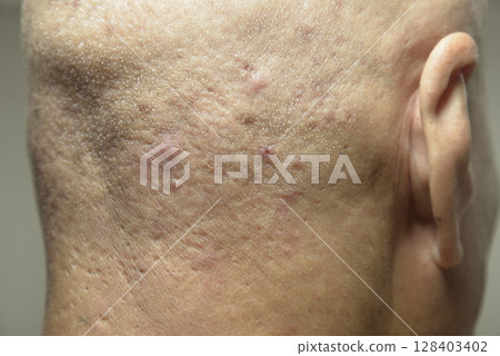 老人後腦勺皮膚病 老人後腦勺皮膚病 128403402