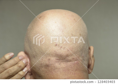 老人後腦勺皮膚病 老人後腦勺皮膚病 128403403