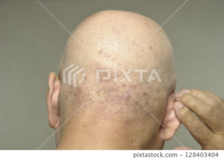 老人後腦勺皮膚病 老人後腦勺皮膚病 128403404
