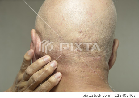 老人後腦勺皮膚病 老人後腦勺皮膚病 128403405