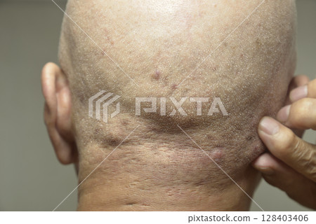 Skin disease on the back of the head of seniors 128403406