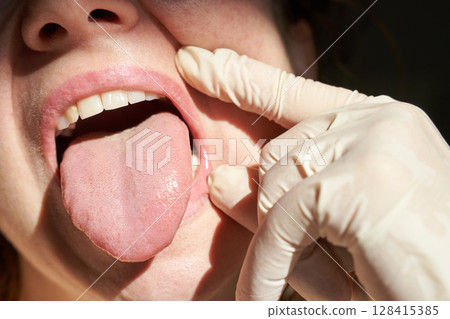 Close-up of female mouth with tongue out and gloved hand examining inside oral Close-up of female mouth with tongue out and gloved hand examining inside oral 128415385
