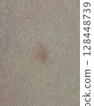 Skin, eczema, close-up 128448739