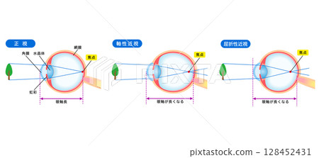 眼睛的結構、正常視力、軸心近視、屈光性近視、視力 128452431