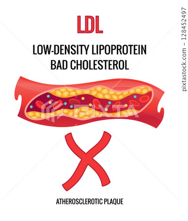 Type of cholesterol in human blood vessels. Narrowed artery for explanation diseases. Low-Density Lipoprotein LDL . Vector illustration Type of cholesterol in human blood vessels. Narrowed artery for explanation diseases. Low-Density Lipoprotein LDL . Vector illustration 128452497