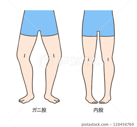Women with bow legs and knock knees, external and internal rotation of the lower limbs 128458769