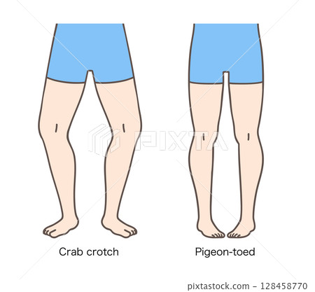 患有羅圈腿和膝內翻的女性，下肢外旋和內旋 128458770