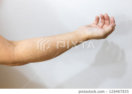 Sweat rash on right arm 128467835