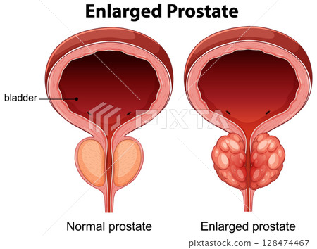 Comparison of Normal and Enlarged Prostate Anatomy 128474467
