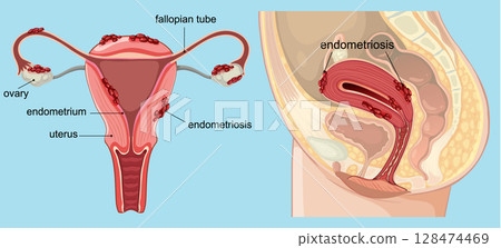 Detailed Medical Illustration of Endometriosis Anatomy 128474469
