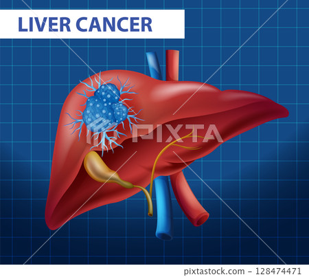 Detailed Vector Illustration of Liver Cancer 128474471
