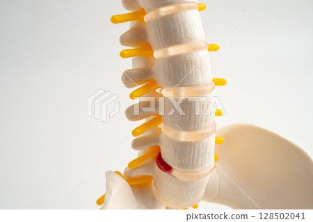 Lumbar spine displaced herniated disc fragment, spinal nerve and bone. Model for treatment medical in the orthopedic department. Lumbar spine displaced herniated disc fragment, spinal nerve and bone. Model for treatment medical in the orthopedic department. 128502041