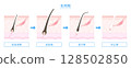 Illustration of the hair cycle (anagen, catagen, telogen) 128502850