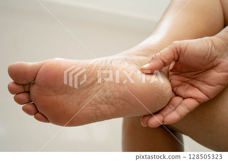 Asian woman check feet with crack and dry heel skin, Diabetic Foot. Asian woman check feet with crack and dry heel skin, Diabetic Foot. 128505323