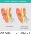 Temporal Branch of the Facial Nerve and Facial Expression. Illustrates the temporal branch of the facial nerve and its role in controlling muscles responsible for facial expression. 128506471