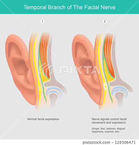 Temporal Branch of the Facial Nerve and Facial Expression. Illustrates the temporal branch of the facial nerve and its role in controlling muscles responsible for facial expression. Temporal Branch of the Facial Nerve and Facial Expression. Illustrates the temporal branch of the facial nerve and its role in controlling muscles responsible for facial expression. 128506471