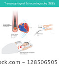 illustrates the Transesophageal Echocardiography (TEE) procedure, a diagnostic medical imaging technique used to obtain detailed images of the heart. 128506505