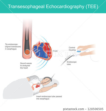 illustrates the Transesophageal Echocardiography (TEE) procedure, a diagnostic medical imaging technique used to obtain detailed images of the heart. 128506505