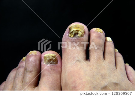 Toes, Fingers, Nails, Athlete's foot 128509507