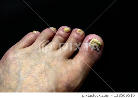 Toes, Fingers, Nails, Athlete's foot Toes, Fingers, Nails, Athlete's foot 128509510