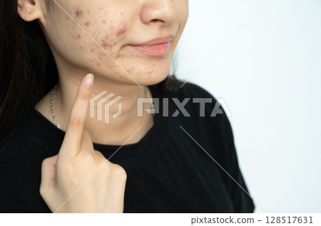 Cropped shot of Asian woman pointing to acne problems on her face. Inflamed acne consists of swelling, redness, and pores that are deeply clogged with bacteria, oil, and dead skin cells. Cropped shot of Asian woman pointing to acne problems on her face. Inflamed acne consists of swelling, redness, and pores that are deeply clogged with bacteria, oil, and dead skin cells. 128517631