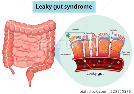 Leaky Gut Syndrome Intestinal Wall Vector Illustration 128525576