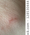 Skin wound close-up 128530444