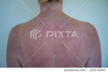 Sunburned back of a woman with peeling skin after sun exposure 128538947