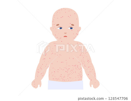 The most common viral rashes 128547706