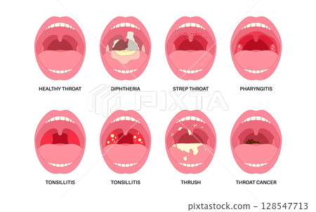 Oropharyngeal infections poster Oropharyngeal infections poster 128547713