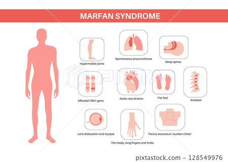 Marfan syndrome poster 128549976