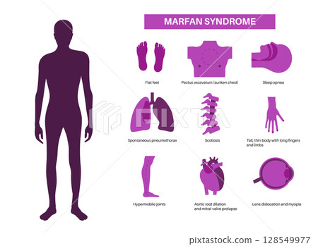 Marfan syndrome poster 128549977