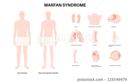 Marfan syndrome poster 128549979