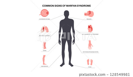 Marfan syndrome poster 128549981