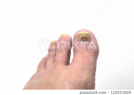 Athlete's foot, nails, fingers, feet Athlete's foot, nails, fingers, feet 128553809