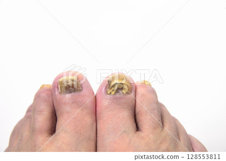 腳癬、指甲、手指、腳 128553811