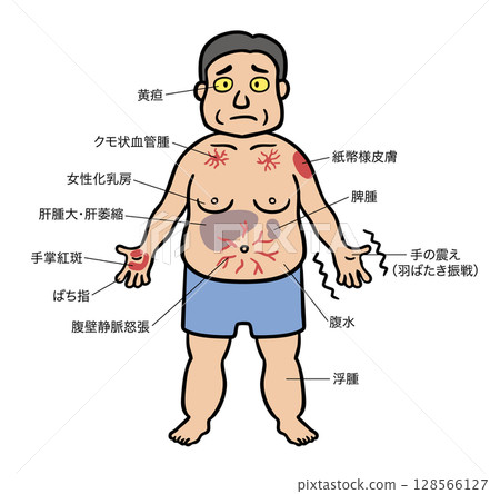 一名中年男子出現肝硬化症狀的插圖 一名中年男子出現肝硬化症狀的插圖 128566127