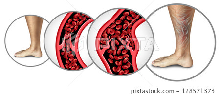 chronic venous insufficiency chronic venous insufficiency 128571373