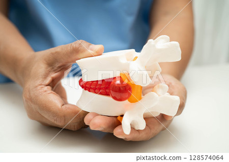 Asian doctor holding spinal nerve and bone model, Lumbar spine displaced herniated disc fragment for treatment medical in the orthopedic department. 128574064