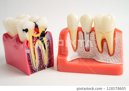 Dental implant, artificial tooth roots into jaw, root canal of dental treatment, gum disease, teeth model for dentist studying about dentistry. 128578605