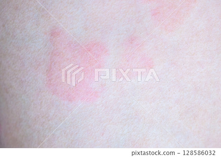 Skin allergy rash dermatitis texture close up Skin allergy rash dermatitis texture close up 128586032